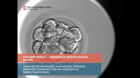 1 PN Embryo Arrest - Nepareizā apaugļošanās ar 1 PN