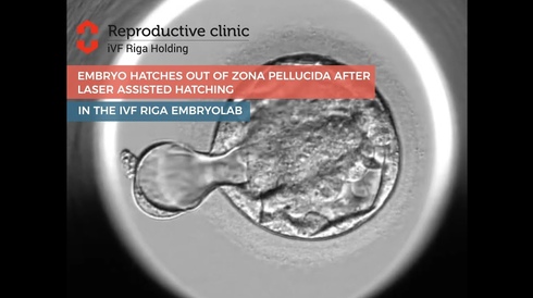 An embryo hatches out of zona pellucida after Laser Assisted Hatching